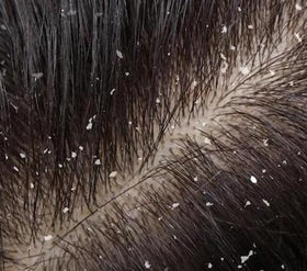 111MedCo scalp in use demonstrating reduced visible flakes and cleaner roots