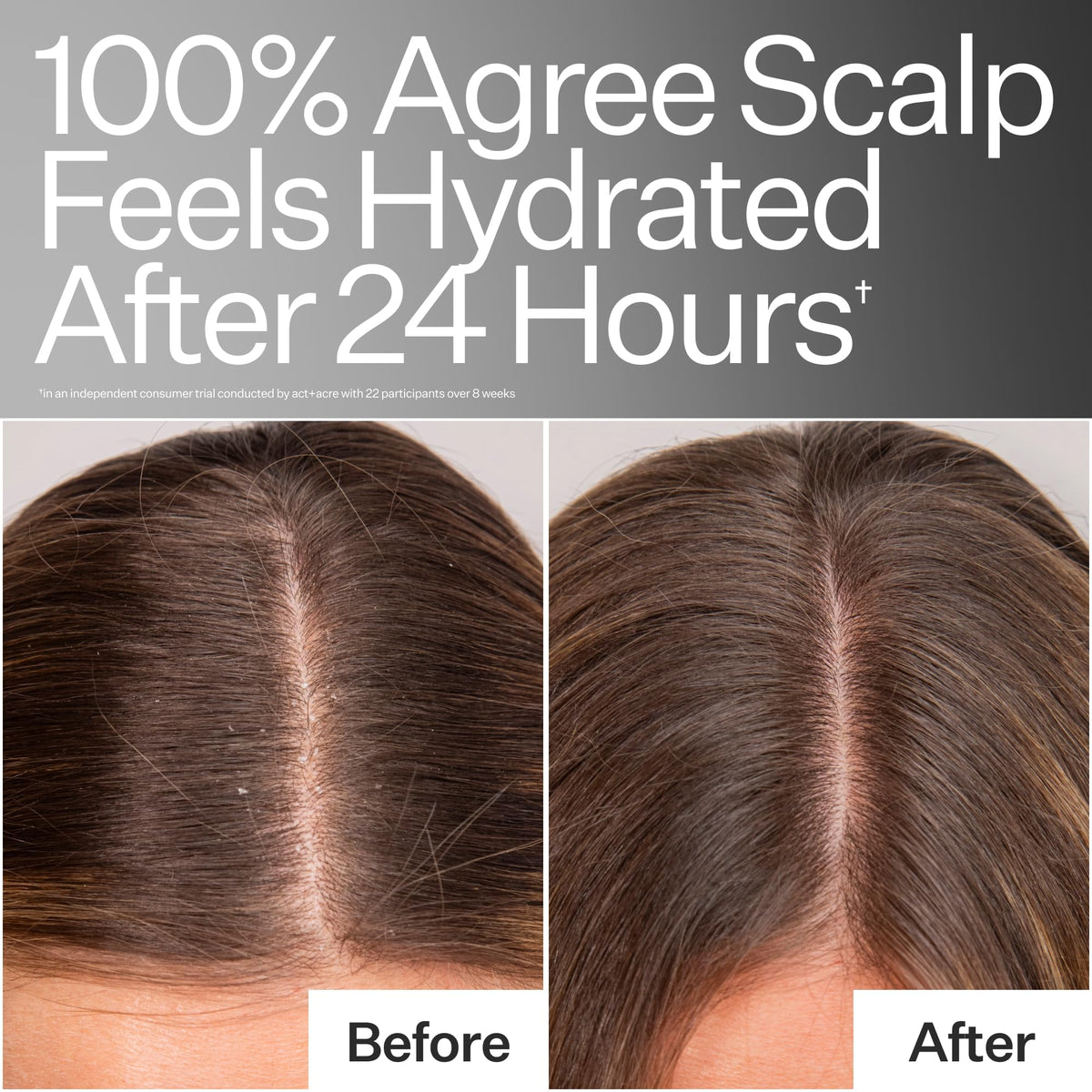 ACT+ ACRE before and after scalp visualization, highlights improved scalp hydration