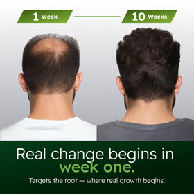 Alphainfuse application on scalp with fingers for targeted nourishment