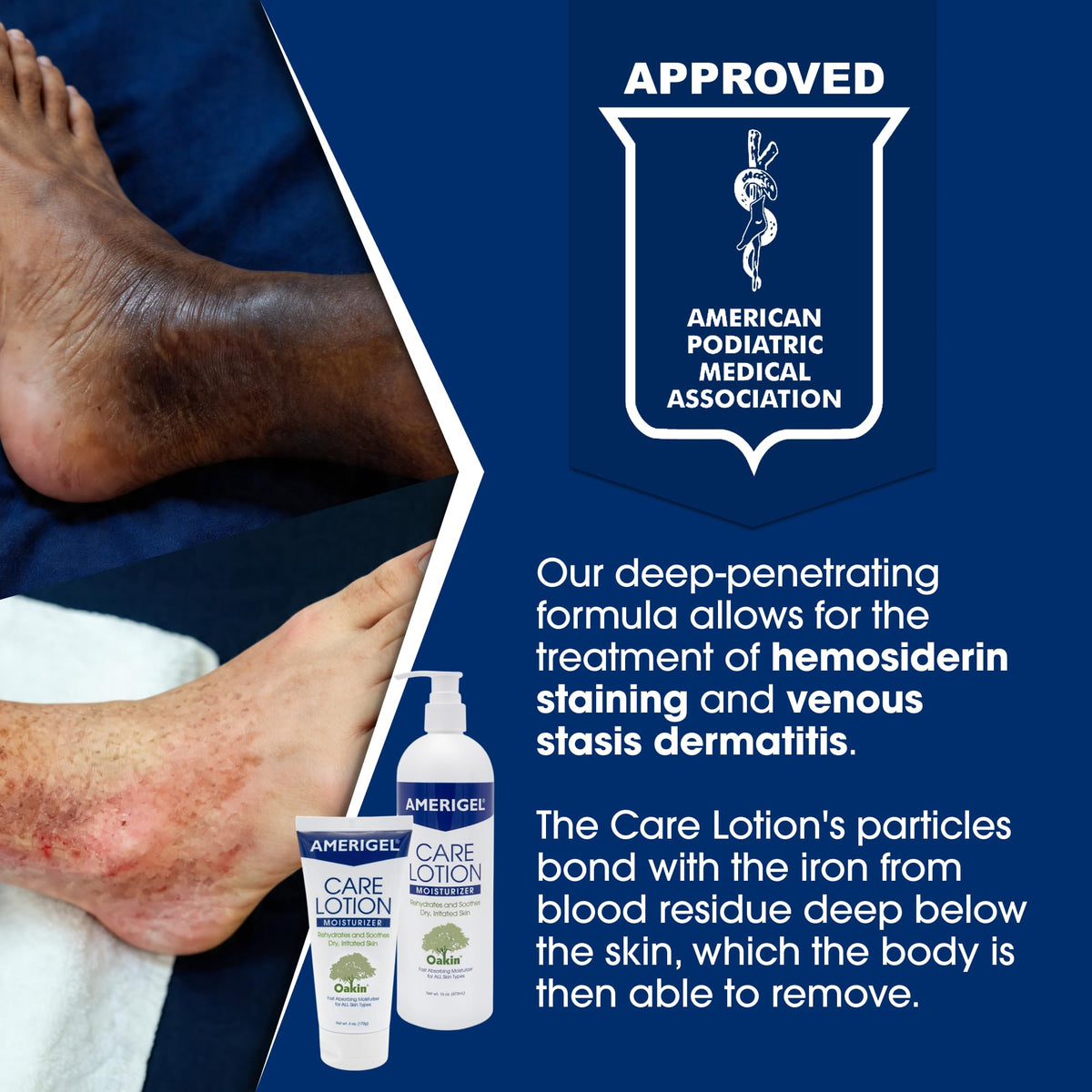 AMERIGEL being applied between toes to soothe and hydrate sensitive foot skin