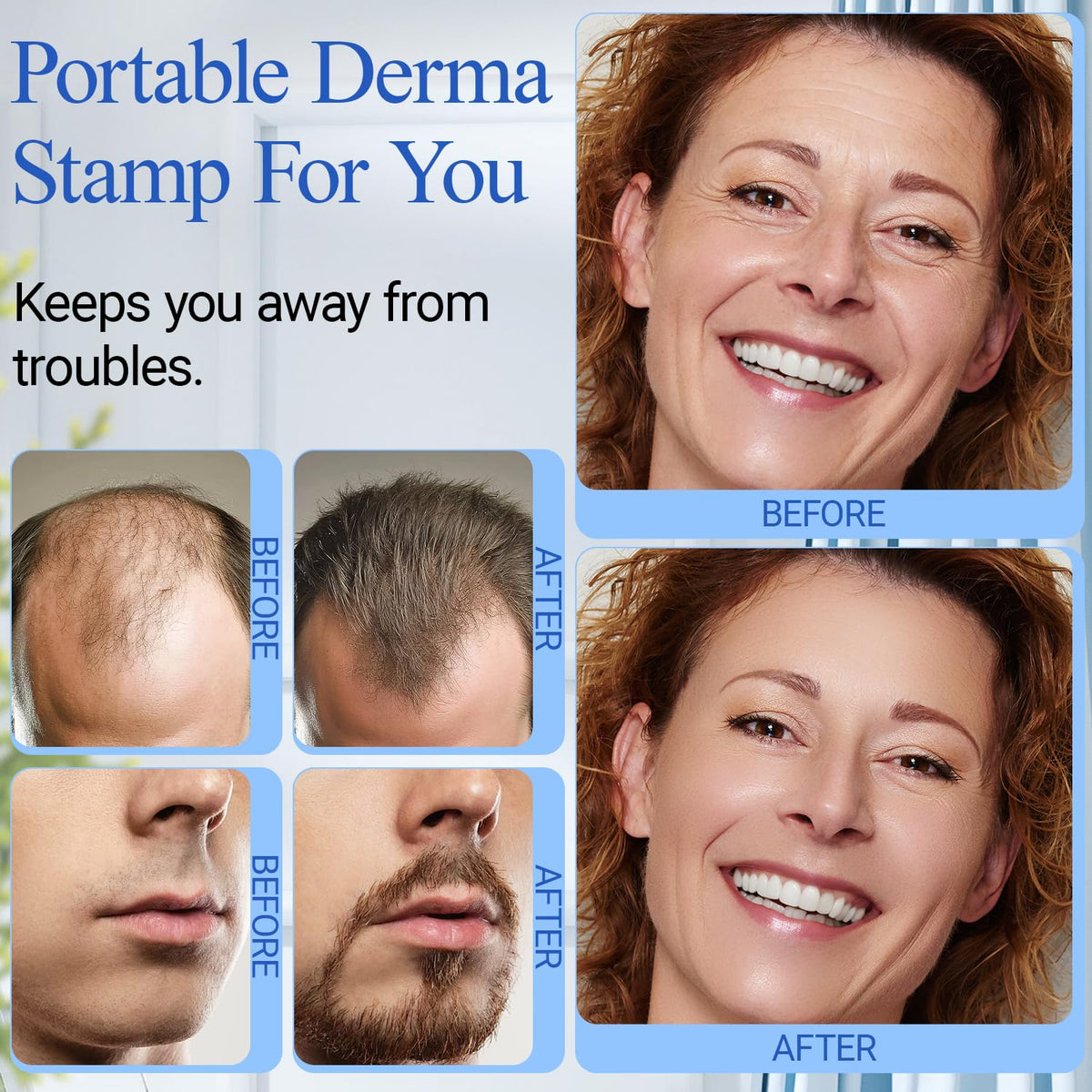 ANSIOVON Derma Stamp applied to beard area illustrating precise grooming support