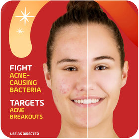 Asepxia applied to cheek blemish demonstrating targeted treatment benefit