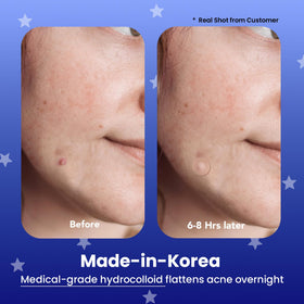 AVARELLE close-up of hydrocolloid texture showing absorbent surface benefit