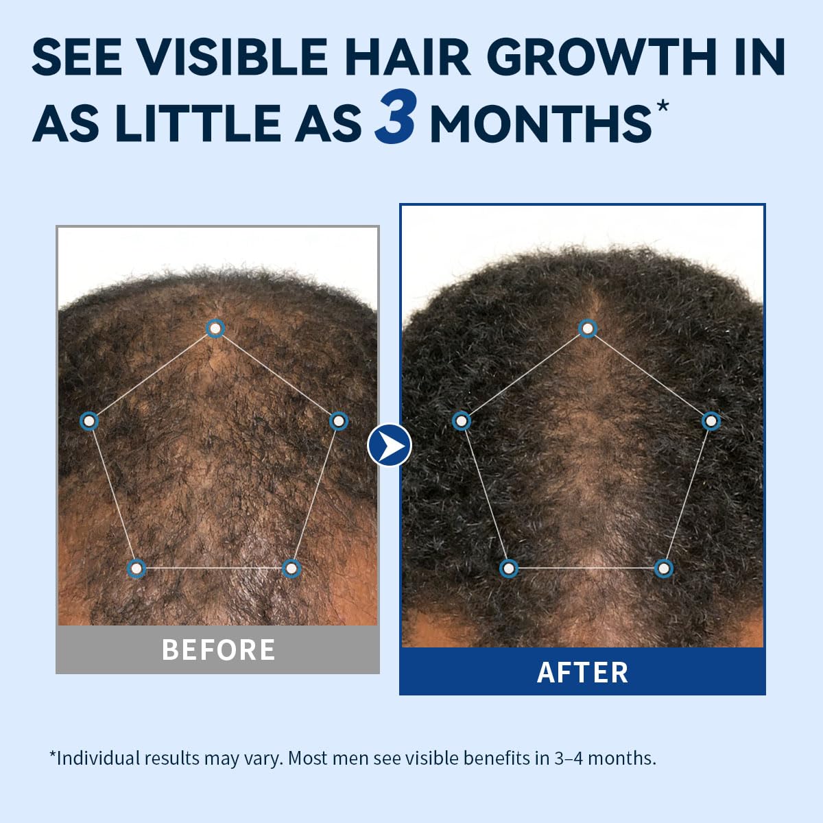 AVITAPURE spray nozzle focused during precise scalp application