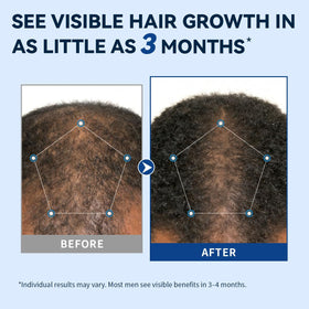 AVITAPURE spray nozzle focused during precise scalp application