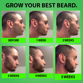 BBS BEST BEARD STUFF applying spray to a patchy cheek area to help target sparse facial hair growth