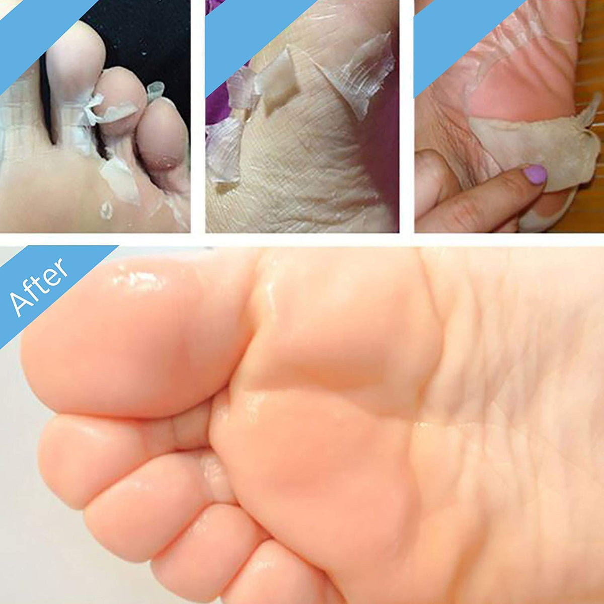 Bealuz feet peeling progress over days showing shedding of dead skin for visible softening benefit results