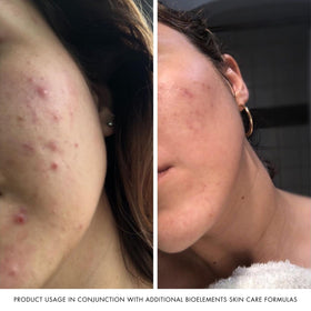 Bioelements morning application on cheeks showing fast absorption and smooth finish