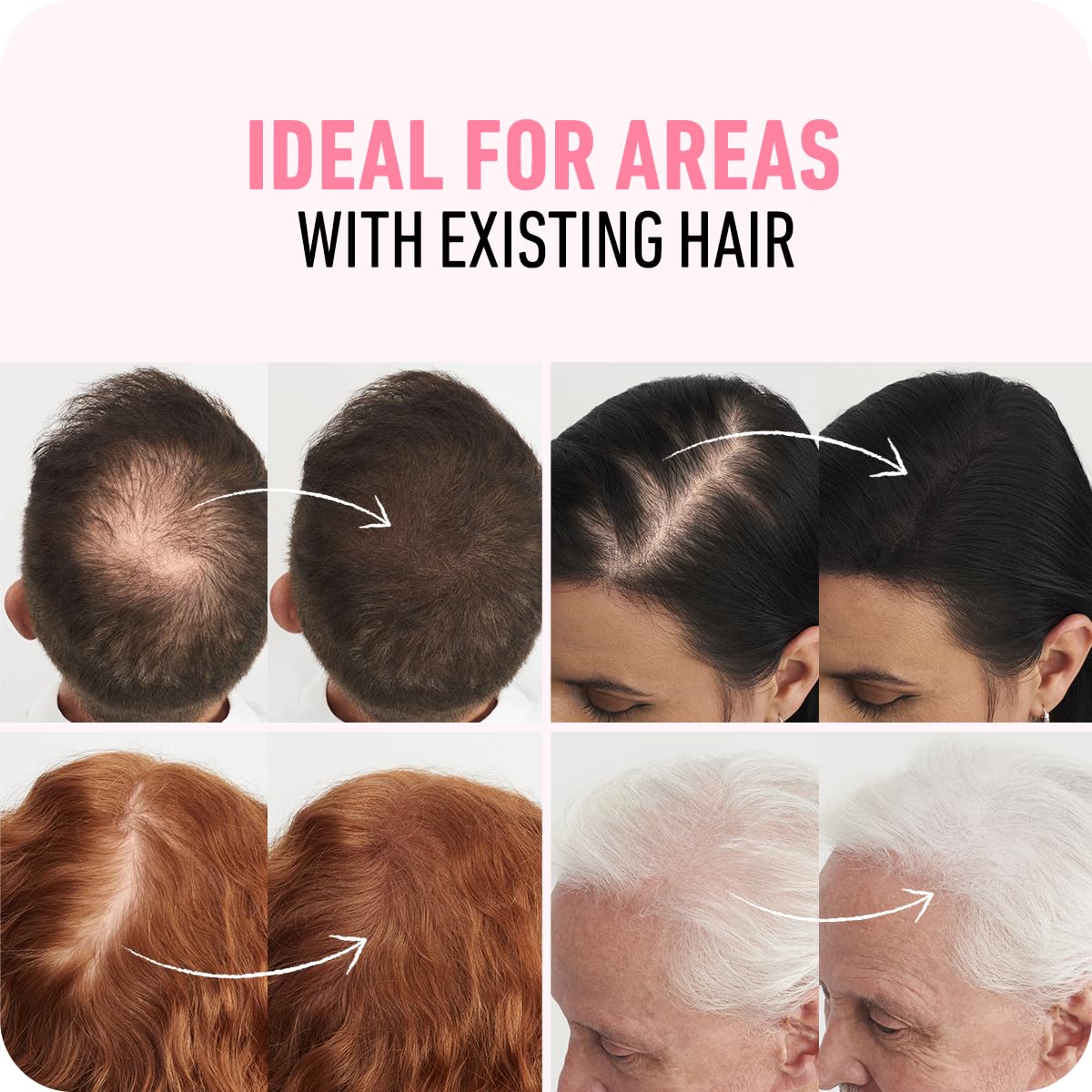 Boldify before and after crown coverage showing fuller appearance