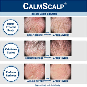 CalmScalp serum texture close-up highlighting lightweight, non-greasy absorption