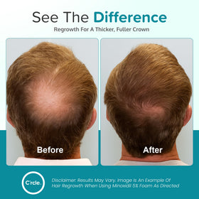C'rcle minoxidil foam being applied to vertex showing targeted coverage advantage