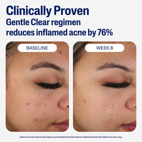 Applying Cetaphil to facial skin to hydrate and help reduce breakouts