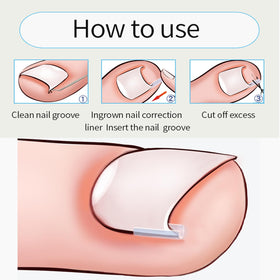 CHEMAILON breathable strip applied on toe demonstrating reduced pressure