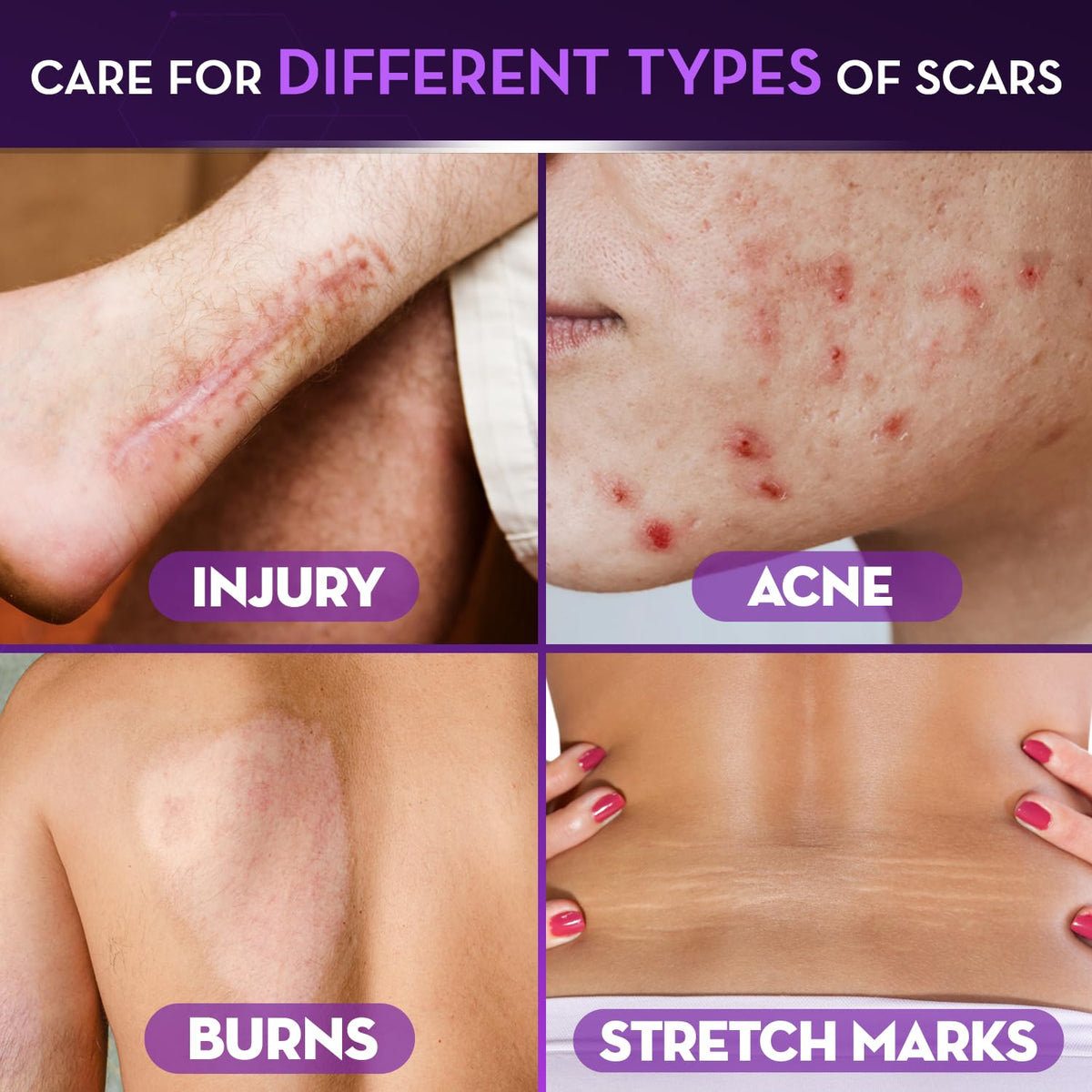 Cicatricure being applied to arm scar for visible improvement