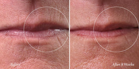 City Beauty applying Line Therapy to upper lip to smooth fine lines