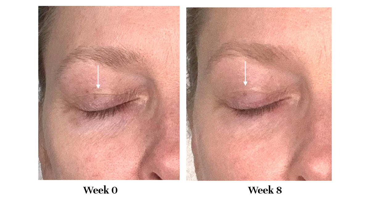 City Beauty side-by-side before and after eyelid appearance showing visible lift