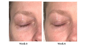 City Beauty side-by-side before and after eyelid appearance showing visible lift