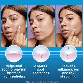 Clearasil patch applied to cheek protecting and promoting healing