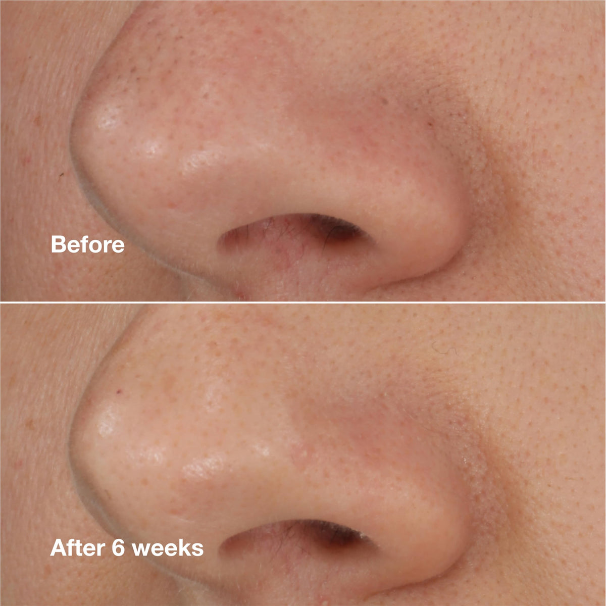 Clinique product applied to nose demonstrating pore-targeting action
