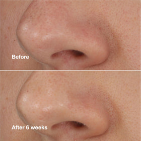 Clinique product applied to nose demonstrating pore-targeting action