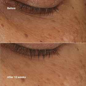 Clinique applicator applying serum under eye, shows precision and de-puffing benefit