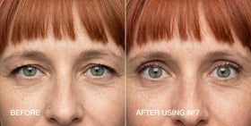 Contours Rx before and after comparison showing noticeable eye symmetry