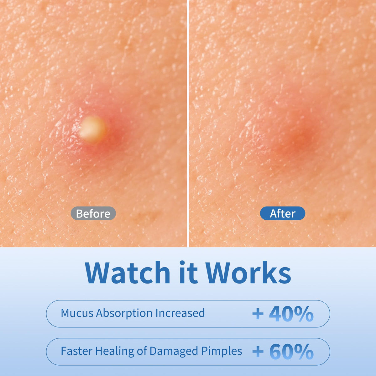 Daolyo patch applied on cheek covering a pimple for discreet protection