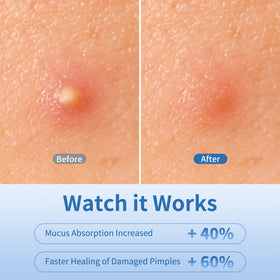 Daolyo patch applied on cheek covering a pimple for discreet protection