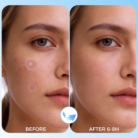 DATISEP patch applied on cheek protecting blemish and reducing touch