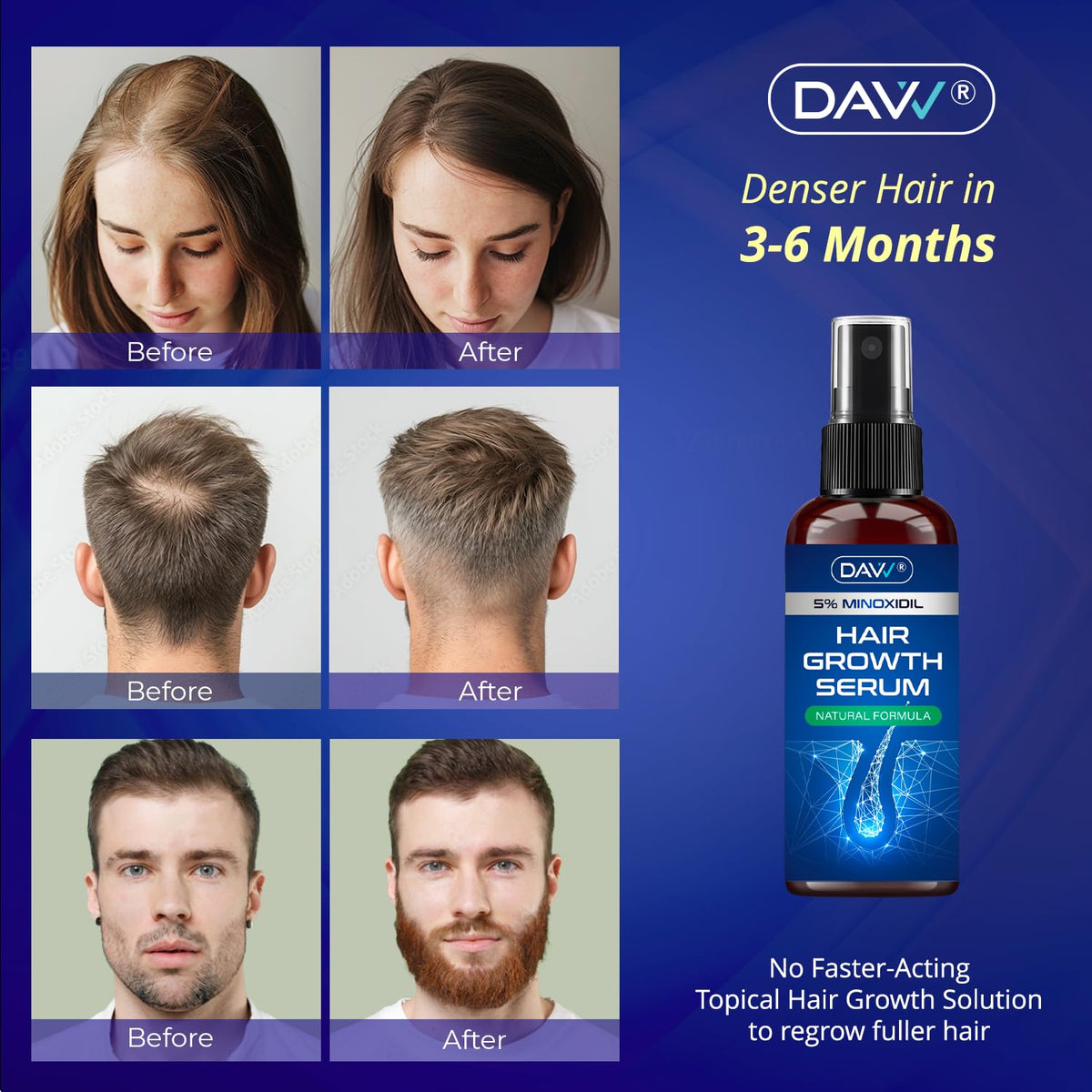 DAVV spray nozzle delivering precise scalp application for coverage