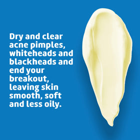 De La Cruz used on back showing body acne treatment benefit