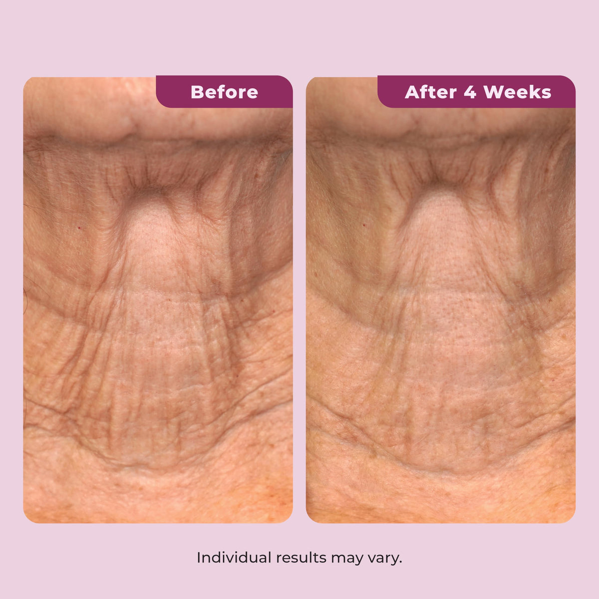 DEKLIDERM smoothed on chest showcasing improved décolleté texture benefit