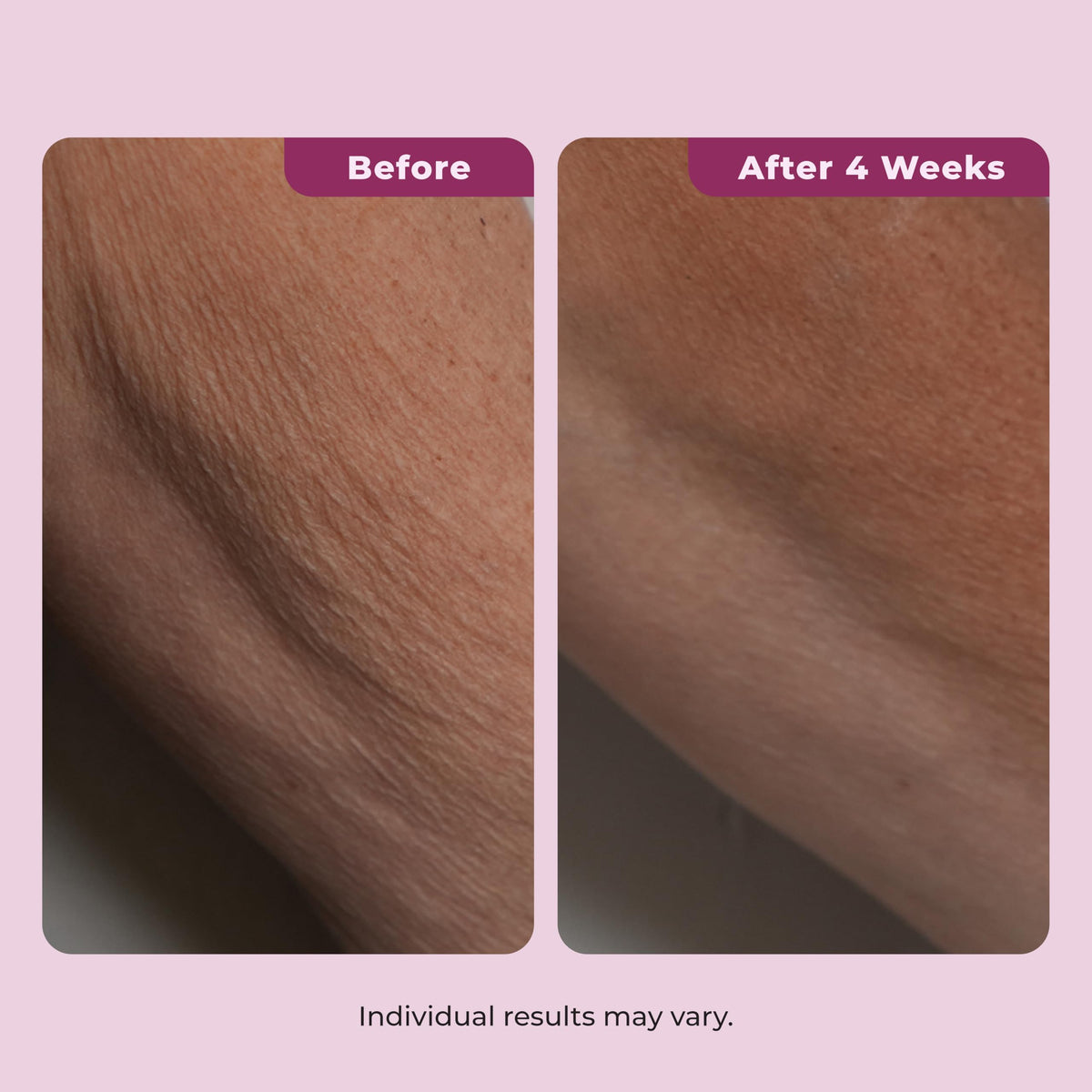 DEKLIDERM applied to neck demonstrating lift and smoother-looking skin benefit