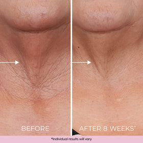 DEKLIDERM ingredients retinol and bakuchiol presented to highlight gentle efficacy