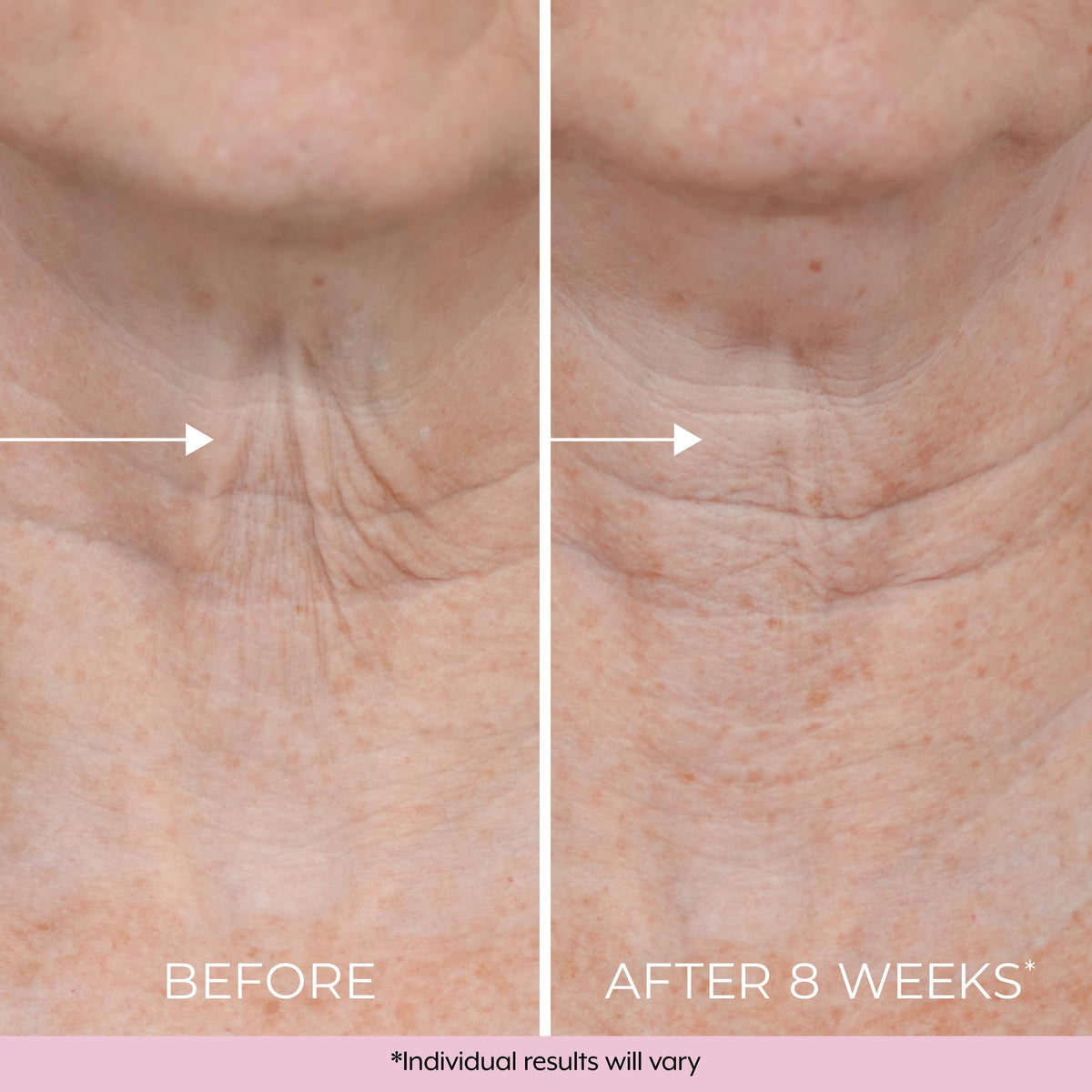 DEKLIDERM applied to upper arm showing reduced crepey appearance benefit