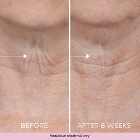DEKLIDERM applied to upper arm showing reduced crepey appearance benefit