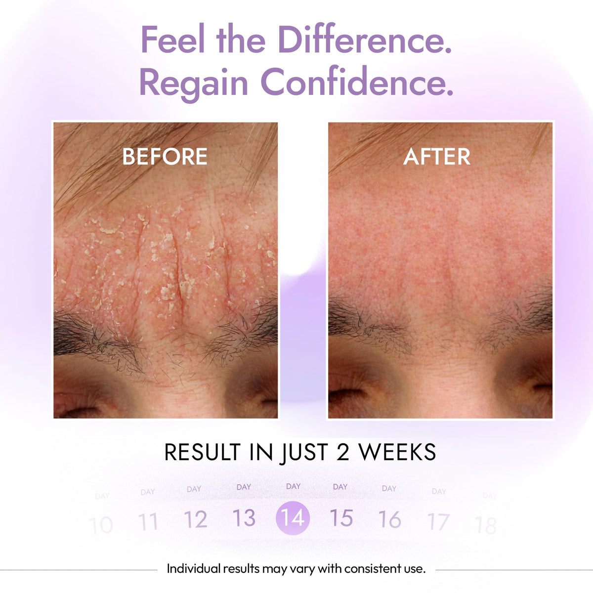 DERMAdoctor cleanser lathering on scalp to help reduce flaking