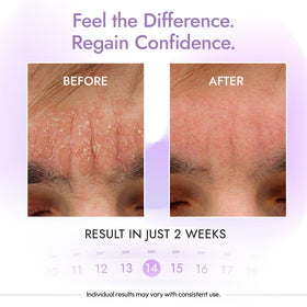 DERMAdoctor cleanser lathering on scalp to help reduce flaking