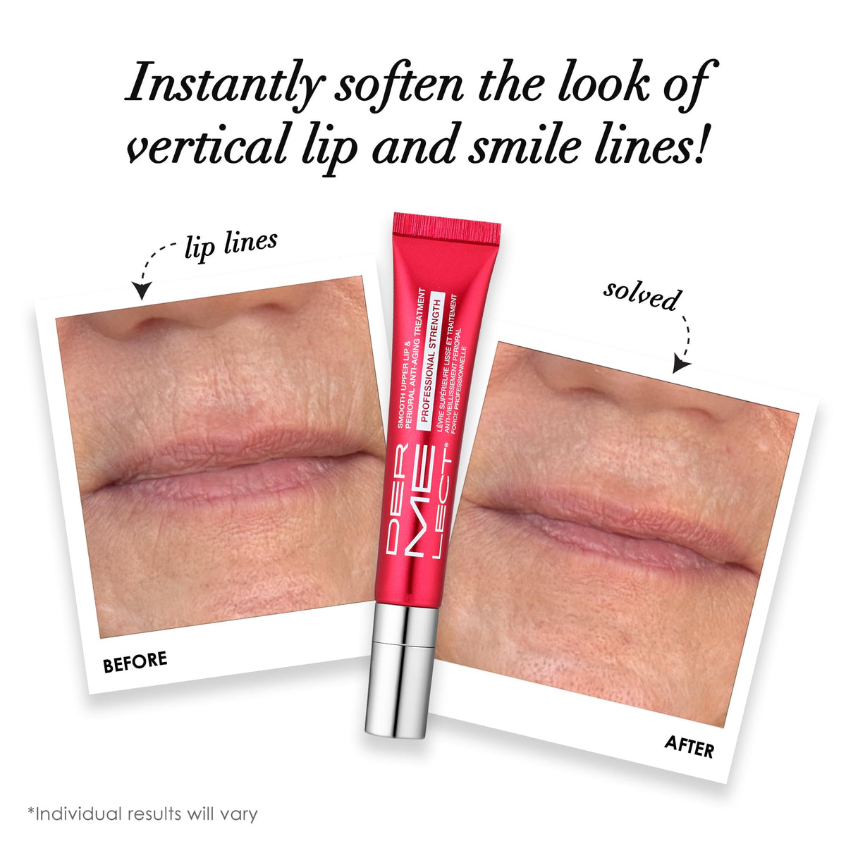 Dermelect ceramic applicator close-up for precise upper lip treatment and less waste