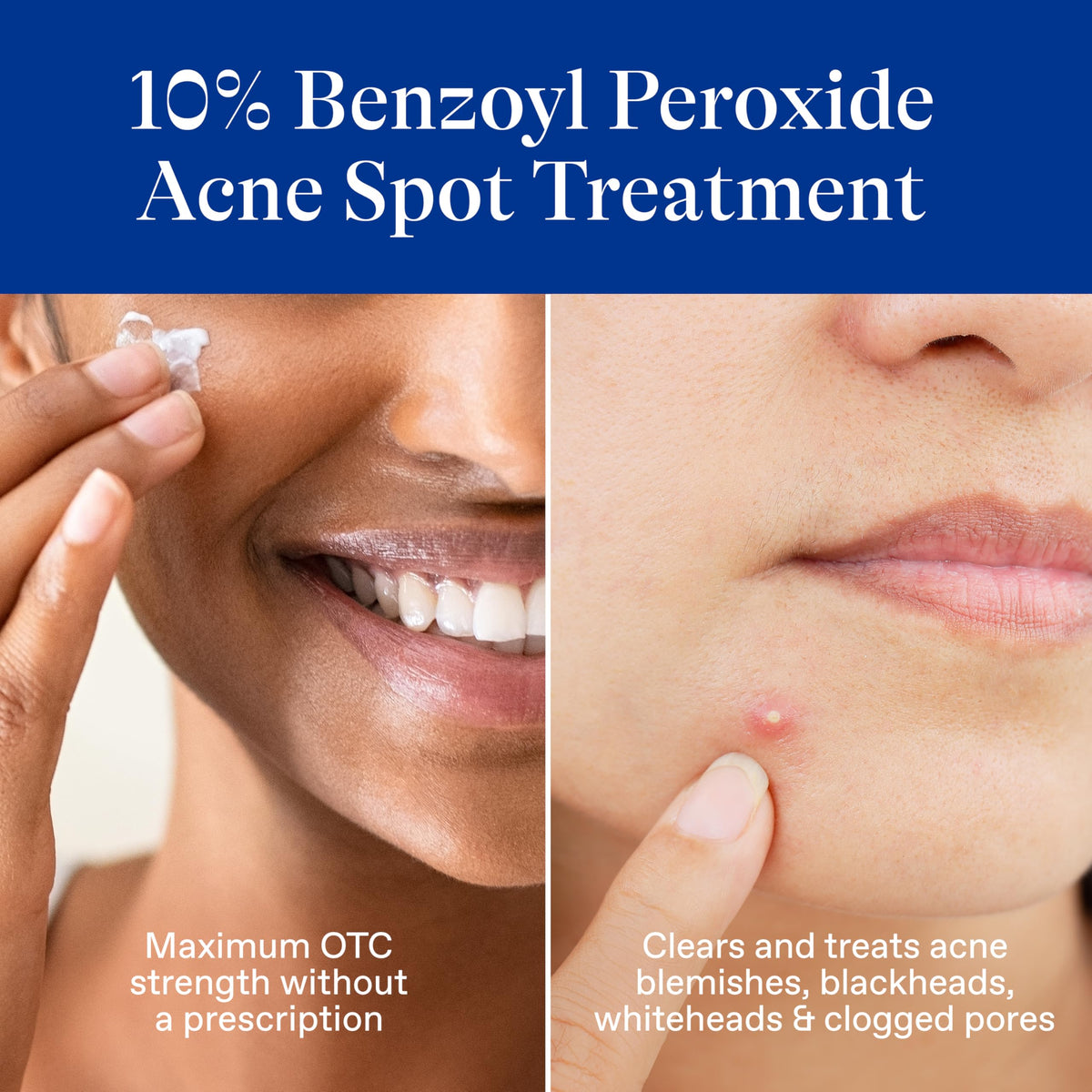 Differin applied on cheek demonstrating targeted blemish treatment