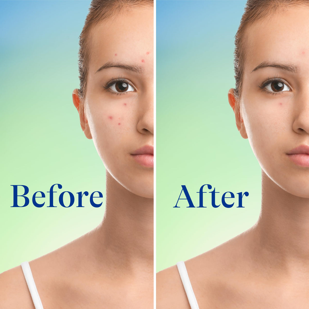 Differin applied to back and chest showing body acne treatment coverage