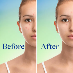 Differin applied to back and chest showing body acne treatment coverage