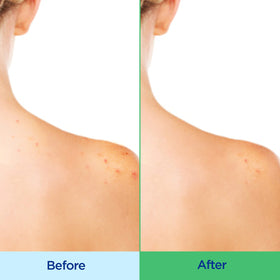 Differin label close-up highlighting 2% salicylic acid and hydrating ingredients, informs users