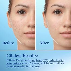 Differin tube staged with sunscreen and cleanser to show complementary routine