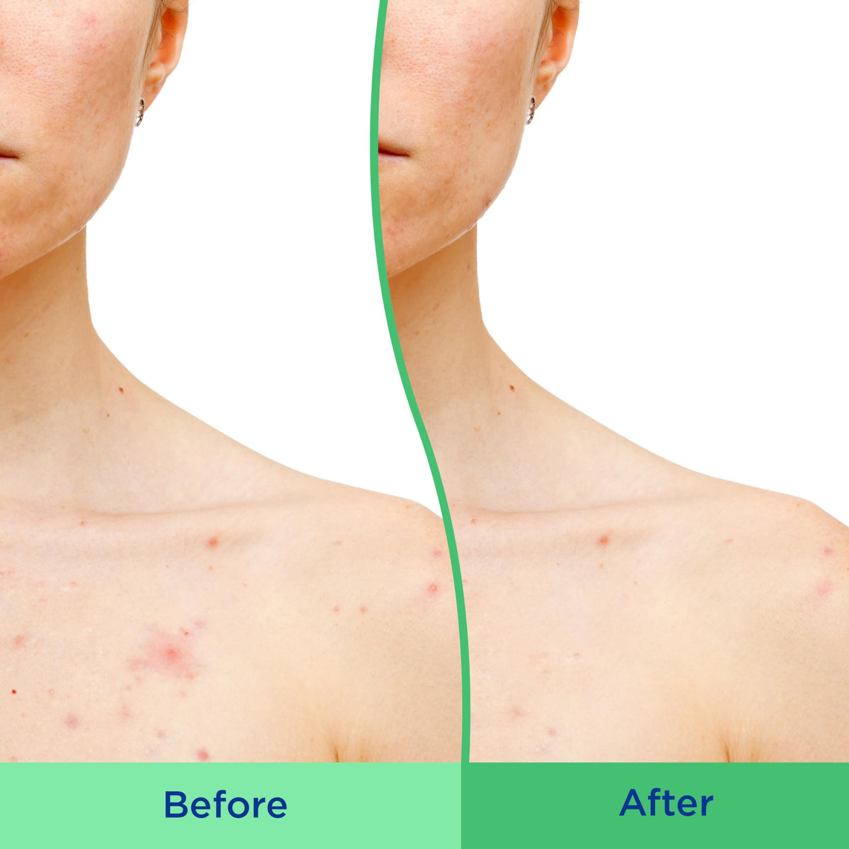 Differin in-shower use on back demonstrating acne-clearing action
