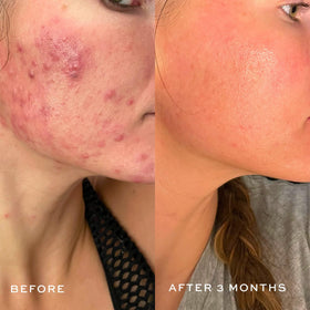 DIME visual of salicylic and glycolic acids representing dual exfoliation benefits