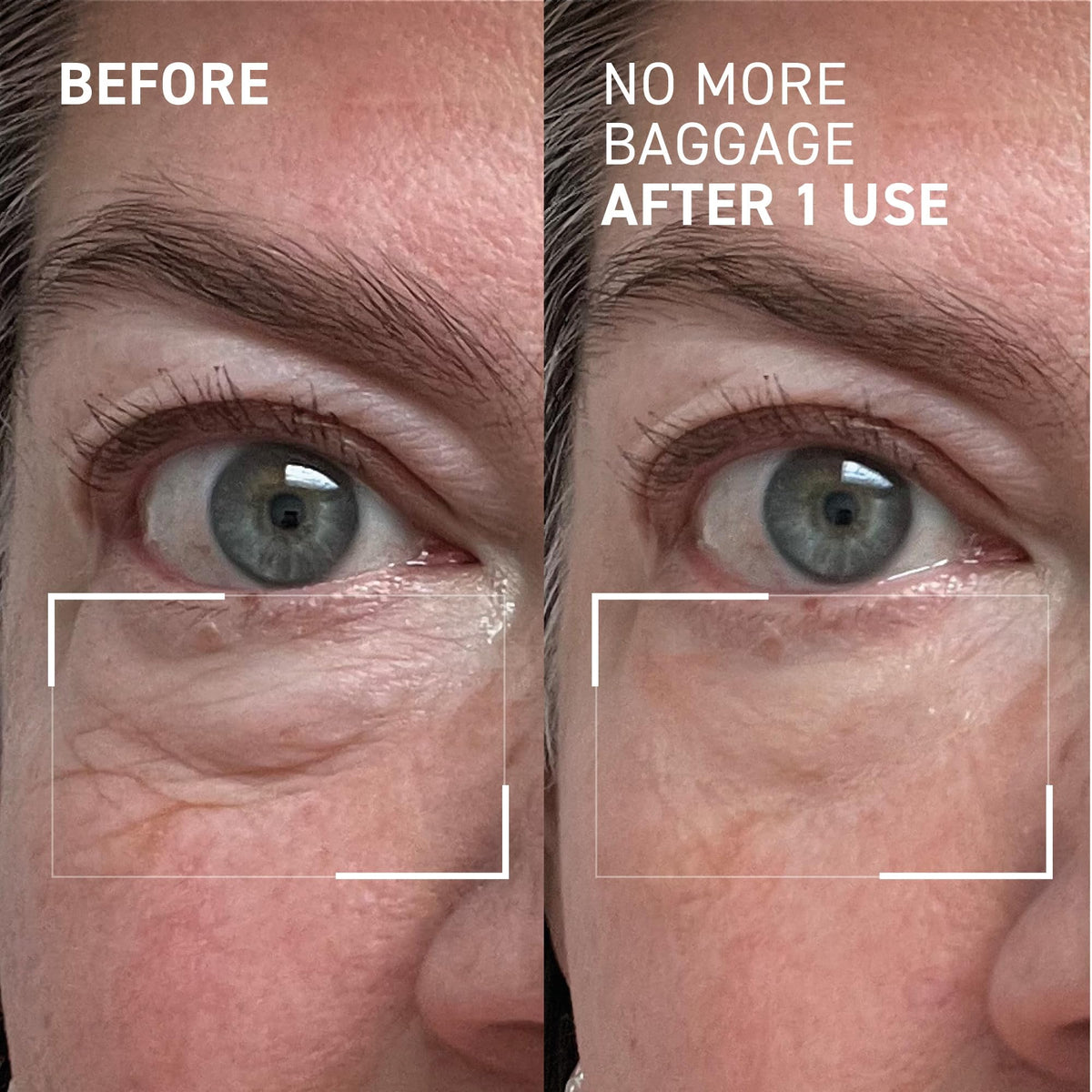 Dr. Brandt before and after comparison illustrating reduced puffiness and brighter eyes