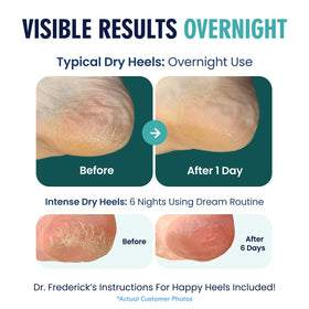 Model wearing Dr. Frederick's socks at night for overnight cracked heel treatment