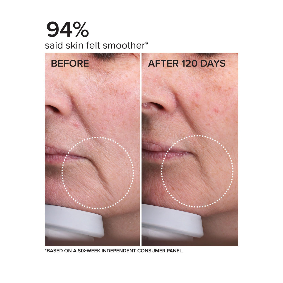 DRMTLGY before and after comparison demonstrating smoother, plumper look