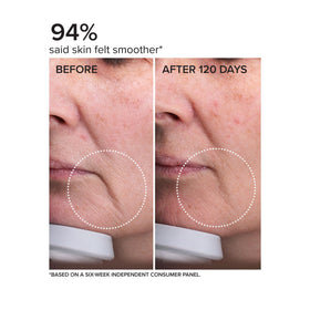 DRMTLGY before and after comparison demonstrating smoother, plumper look